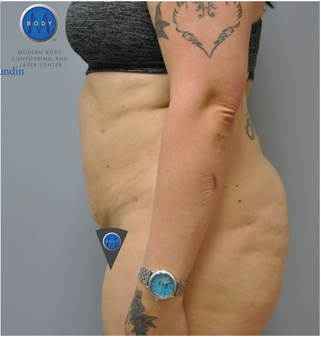 Renuvion J Plasma Before and After | Little Lipo