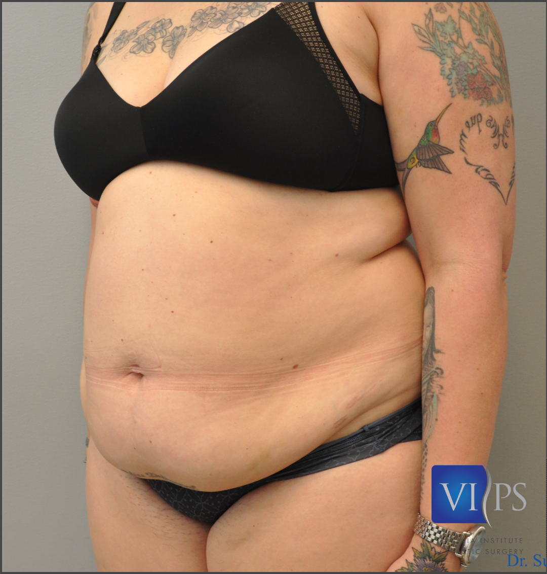 Renuvion J Plasma Before and After | Little Lipo
