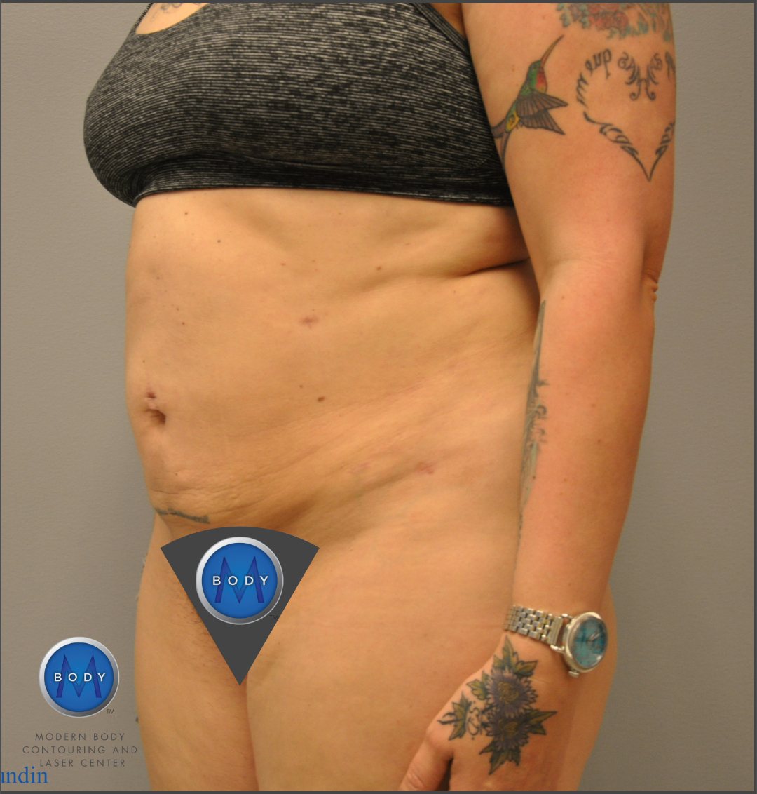 Renuvion J Plasma Before and After | Little Lipo