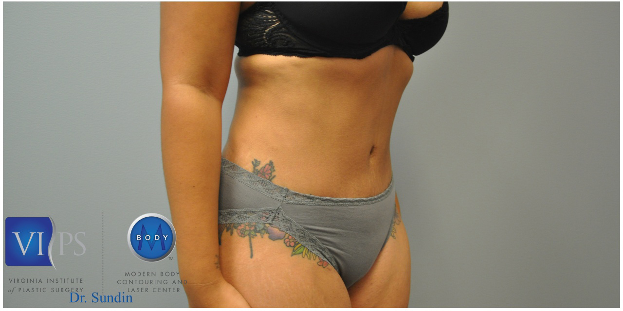 Renuvion J Plasma Before and After | Little Lipo