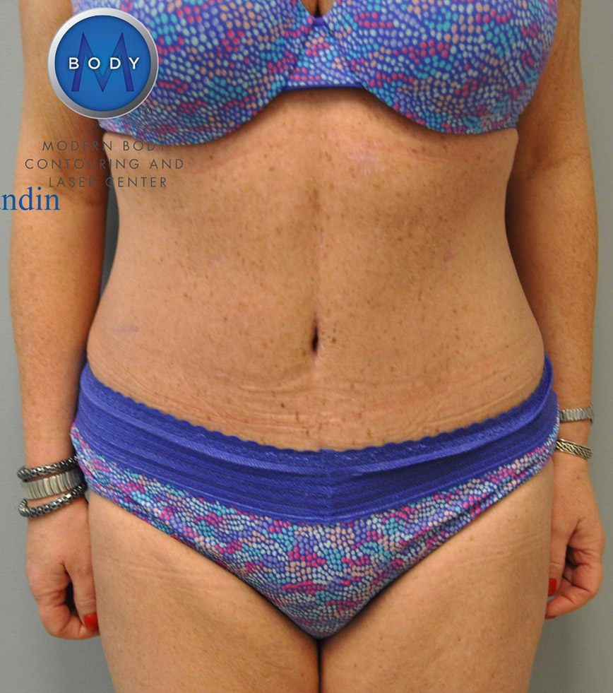 Renuvion J Plasma Before and After | Little Lipo