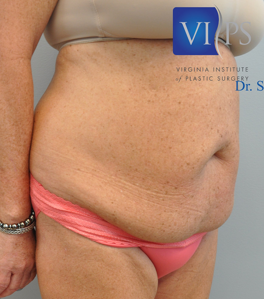 Renuvion J Plasma Before and After | Little Lipo