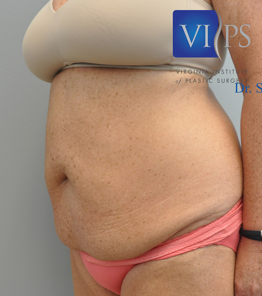 Renuvion J Plasma Before and After | Little Lipo