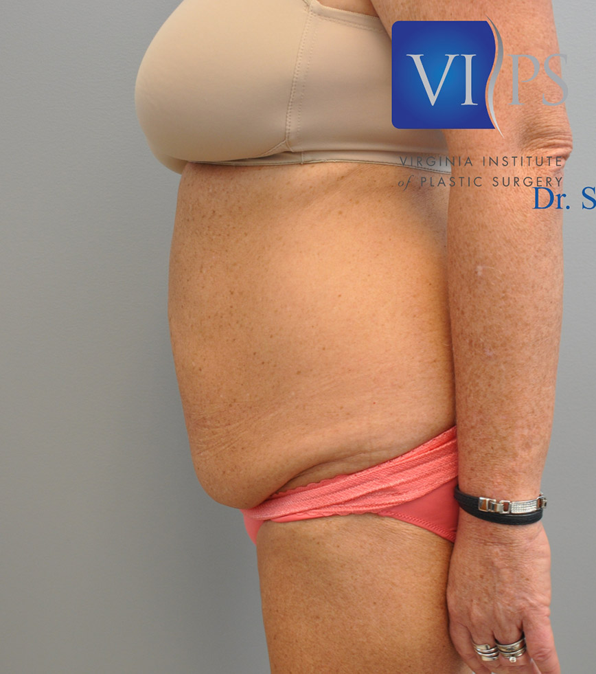 Renuvion J Plasma Before and After | Little Lipo