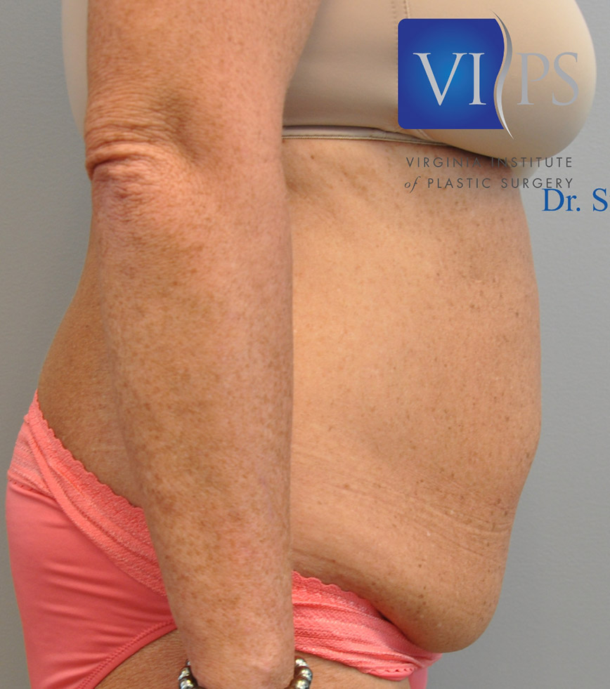 Renuvion J Plasma Before and After | Little Lipo