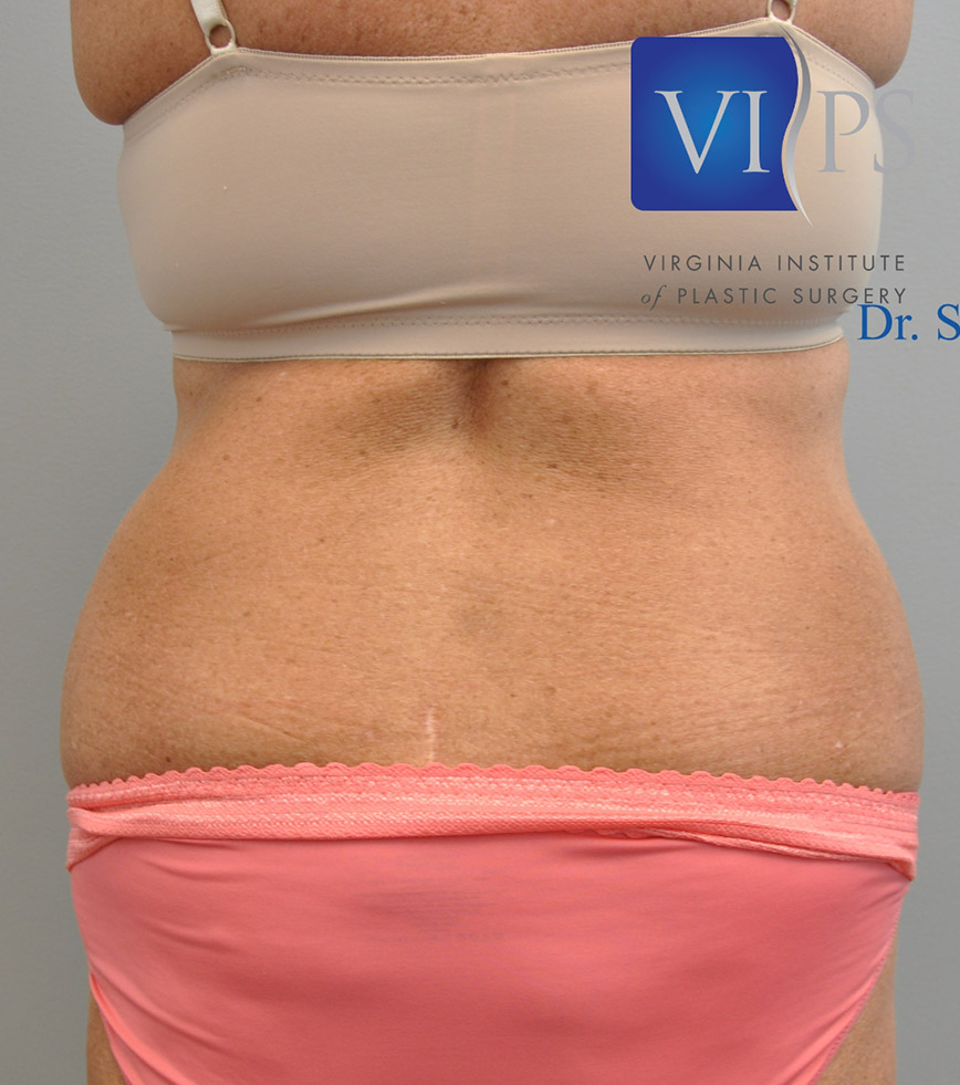 Renuvion J Plasma Before and After | Little Lipo