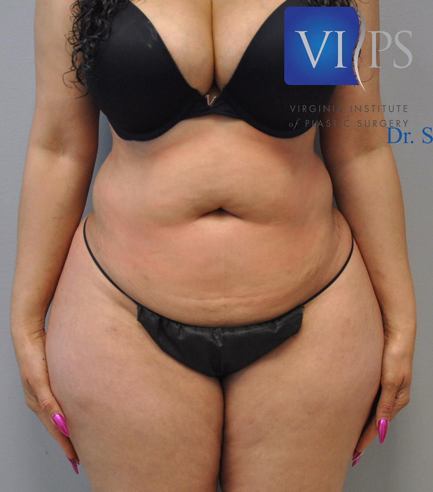 Renuvion J Plasma Before and After | Little Lipo