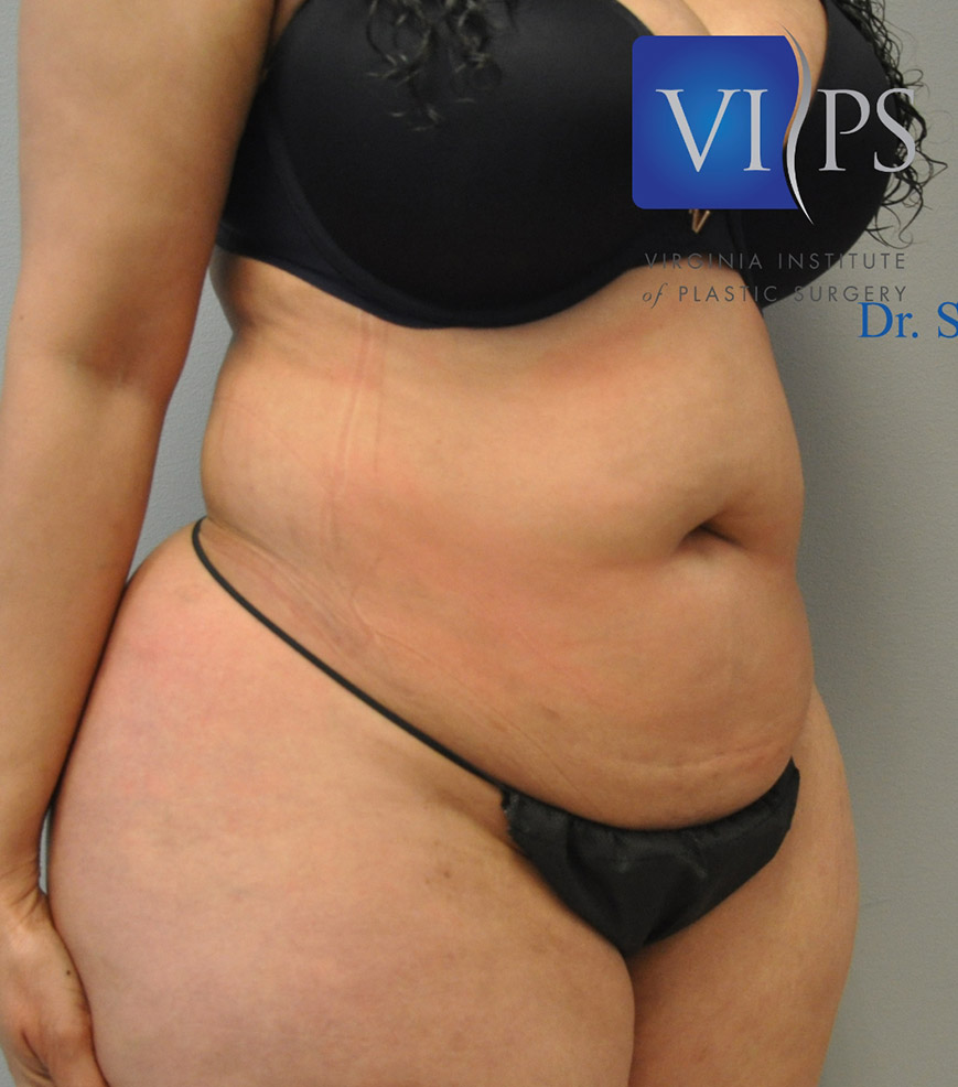 Renuvion J Plasma Before and After | Little Lipo