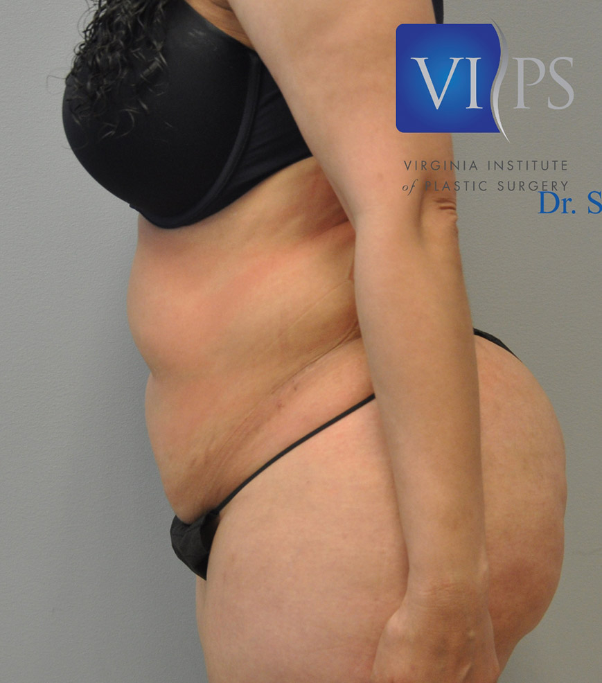 Renuvion J Plasma Before and After | Little Lipo