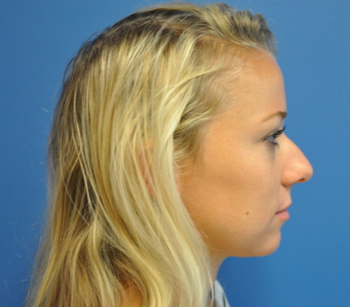 Rhinoplasty Before and After | Little Lipo