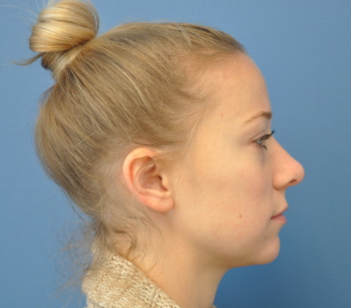 Rhinoplasty Before and After | Little Lipo