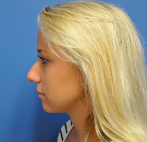 Rhinoplasty Before and After | Little Lipo