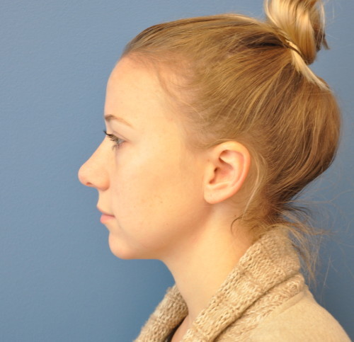 Rhinoplasty Before and After | Little Lipo