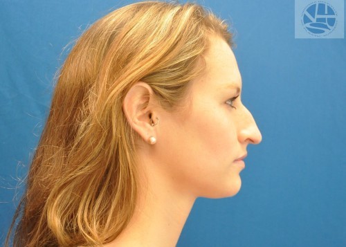 Rhinoplasty Before and After | Little Lipo