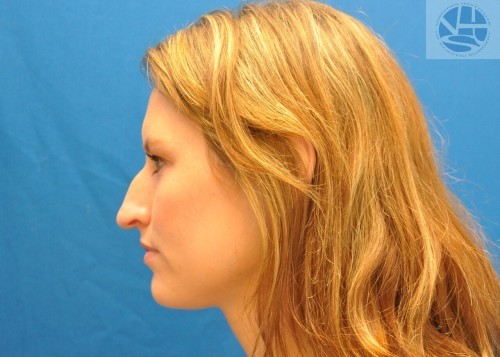 Rhinoplasty Before and After | Little Lipo