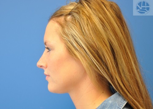 Rhinoplasty Before and After | Little Lipo