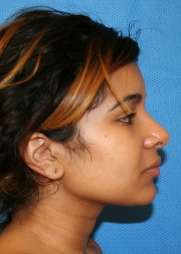 Rhinoplasty Before and After | Little Lipo