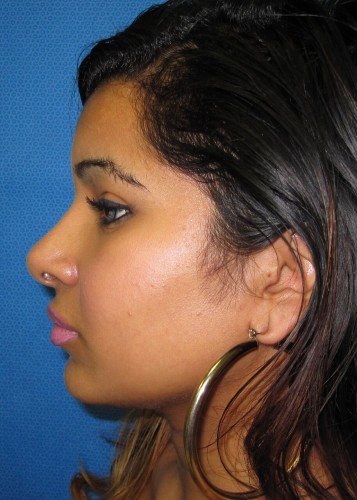 Rhinoplasty Before and After | Little Lipo