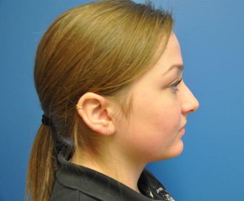 Rhinoplasty Before and After | Little Lipo