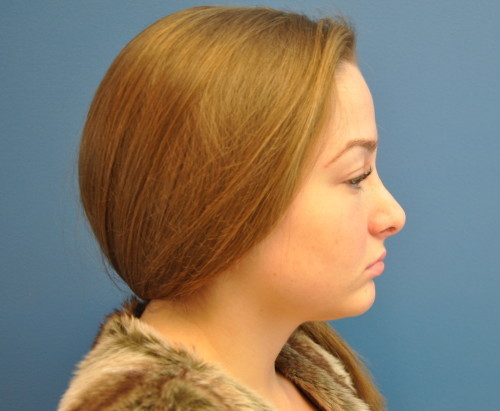 Rhinoplasty Before and After | Little Lipo