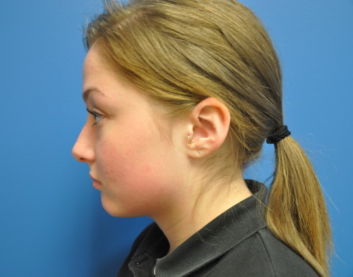 Rhinoplasty Before and After | Little Lipo