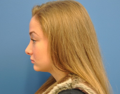 Rhinoplasty Before and After | Little Lipo