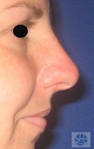 Rhinoplasty Before and After | Little Lipo