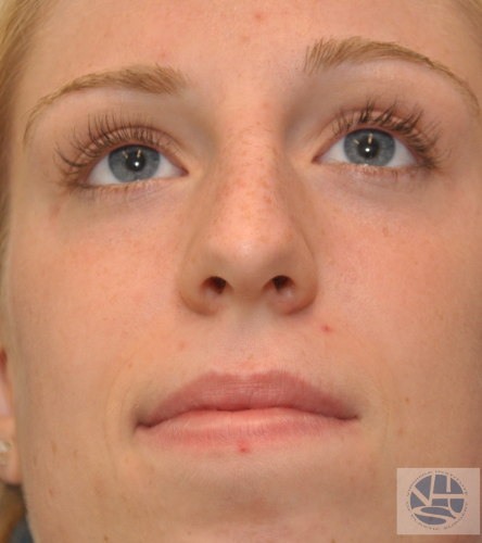 Rhinoplasty Before and After | Little Lipo