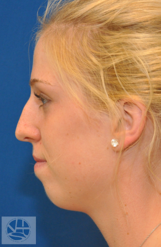 Rhinoplasty Before and After | Little Lipo