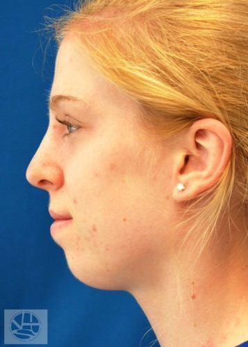 Rhinoplasty Before and After | Little Lipo