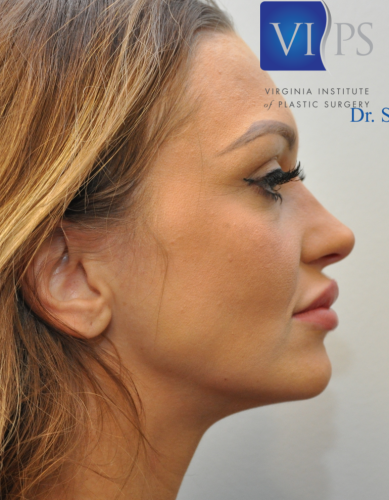 Rhinoplasty Before and After | Little Lipo