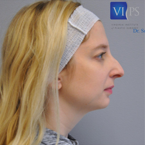 Rhinoplasty Before and After | Little Lipo