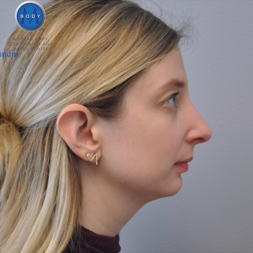 Rhinoplasty Before and After | Little Lipo