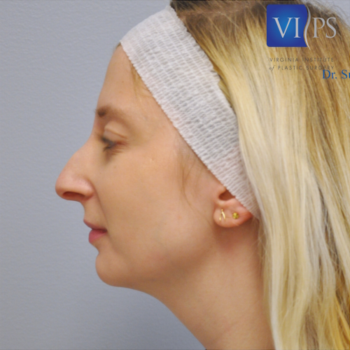 Rhinoplasty Before and After | Little Lipo