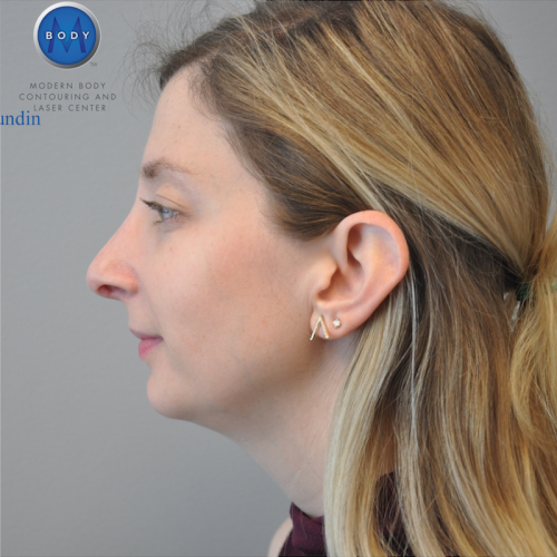 Rhinoplasty Before and After | Little Lipo