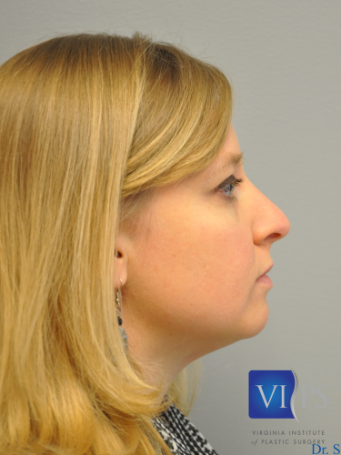 Rhinoplasty Before and After | Little Lipo