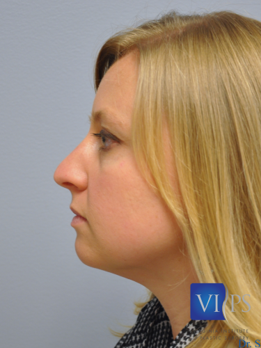 Rhinoplasty Before and After | Little Lipo