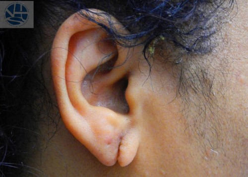 Split Earlobes Before and After | Little Lipo