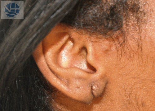 Split Earlobes Before and After | Little Lipo