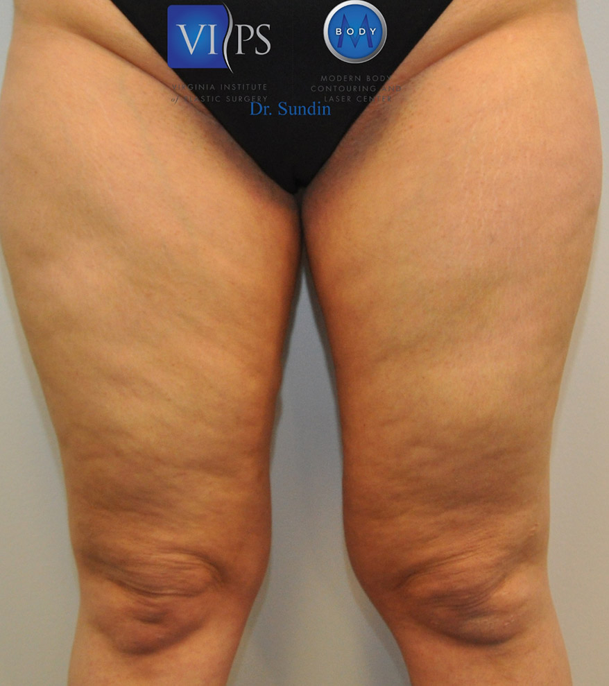 Thigh Liposuction Before and After | Little Lipo