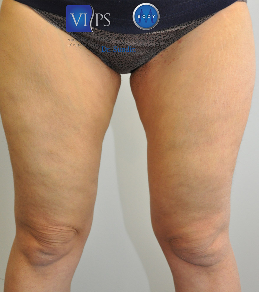 Thigh Liposuction Before and After | Little Lipo