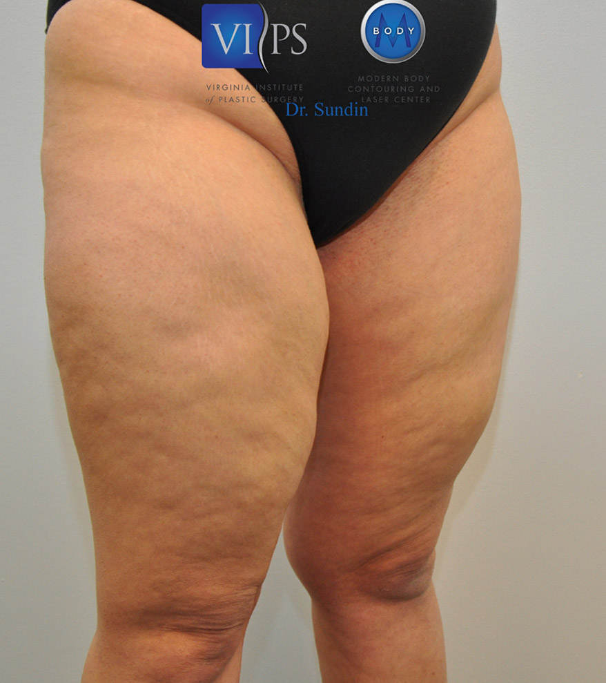 Thigh Liposuction Before and After | Little Lipo