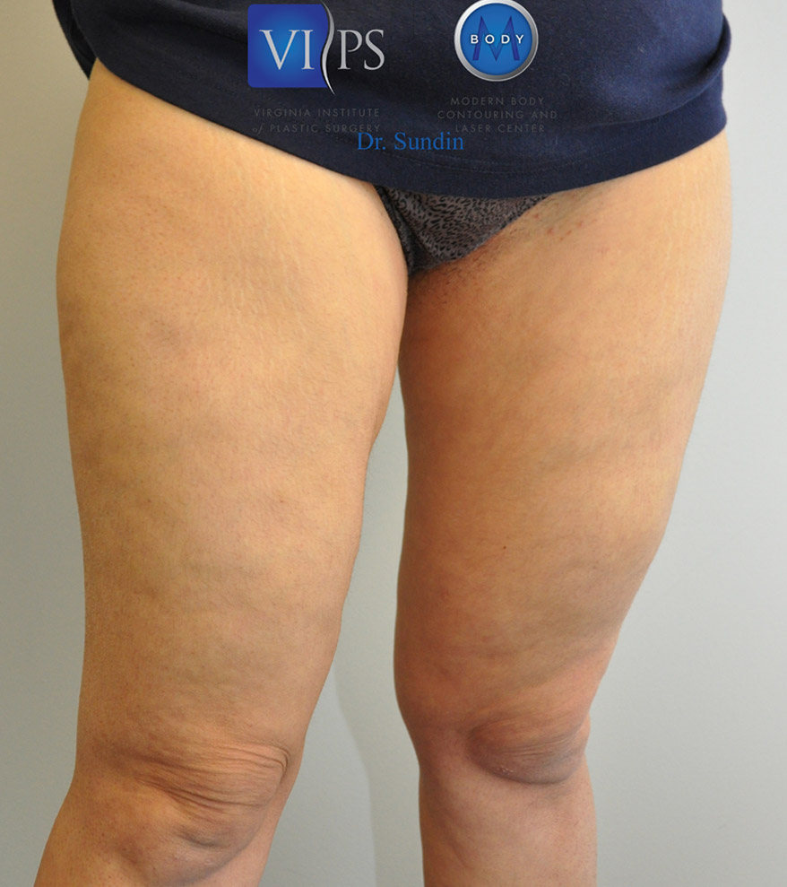 Thigh Liposuction Before and After | Little Lipo