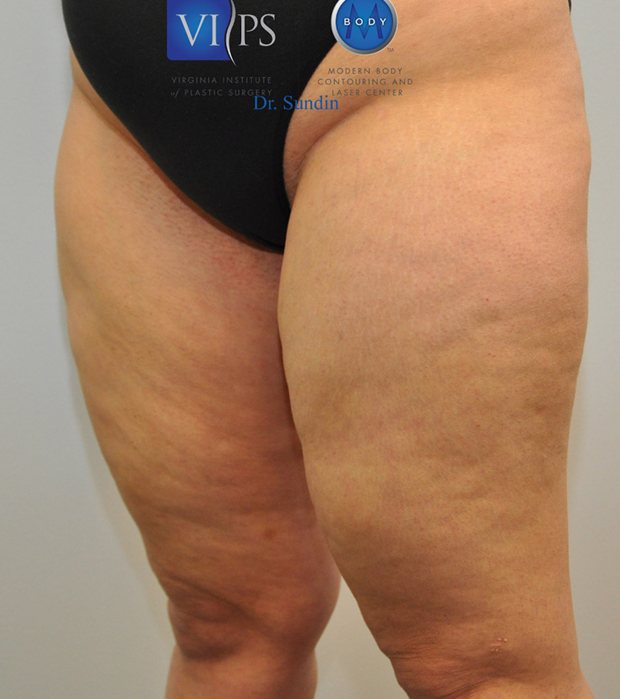 Thigh Liposuction Before and After | Little Lipo