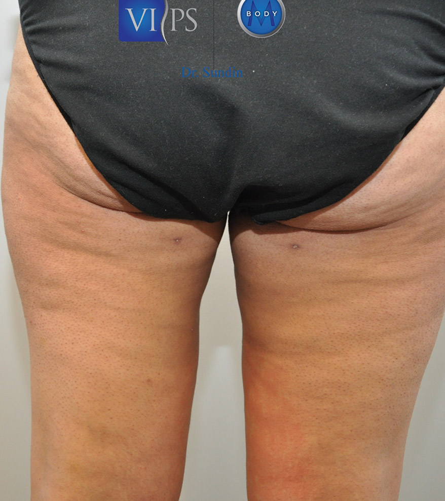 Thigh Liposuction Before and After | Little Lipo