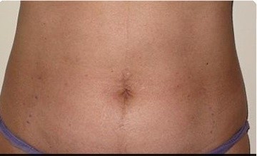 Trusculpt Before and After | Little Lipo