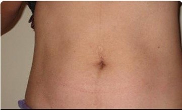 Trusculpt Before and After | Little Lipo