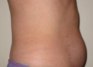 Trusculpt Before and After | Little Lipo