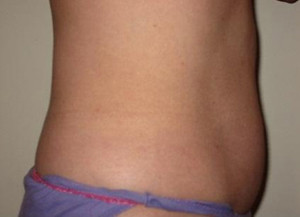 Trusculpt Before and After | Little Lipo