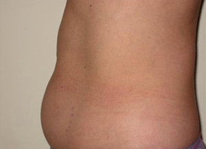 Trusculpt Before and After | Little Lipo